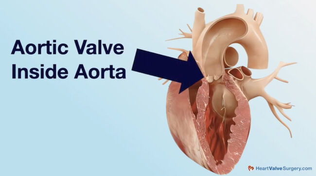 Inside Structure of the Aortic Valve