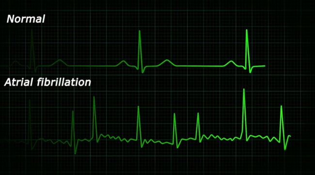 Atrial Fibrillation