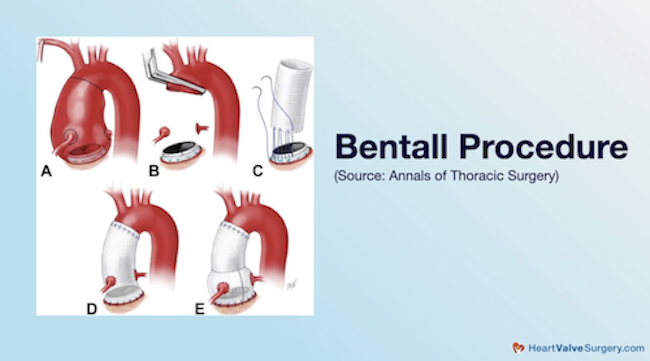 Bentall Procedure