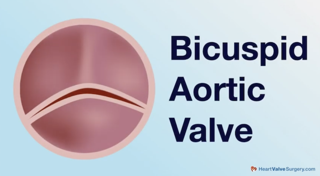 bicuspid aortic valve drawing