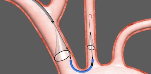 Cerebral Protection Device to Prevent Stroke During TAVR