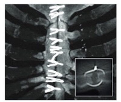 CT Scan of Sternal Wires