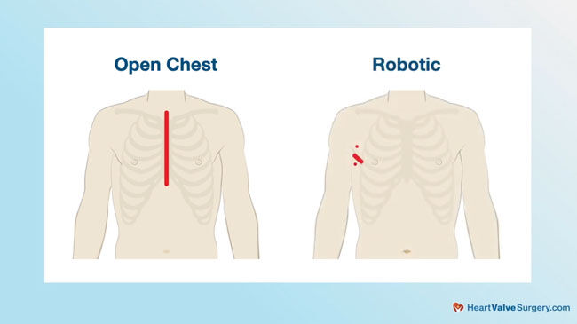 Comparison of Open Heart Incision and Robotic Surgery Incision