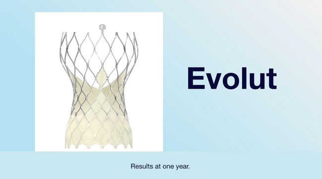 Evolut TAVR Valve Smart Clinical Trial