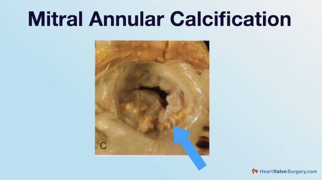 Mitral Annular Calcification Example