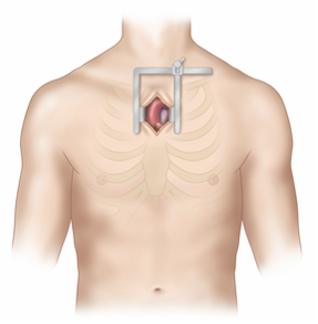 Mini-Hemisternotomy