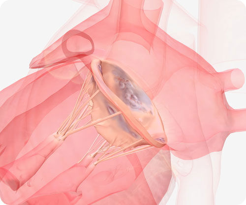 Mitral Valve Prolapse