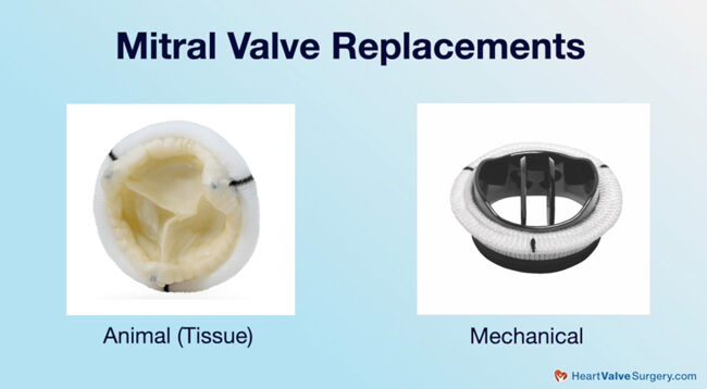 Mitral Valve Replacements