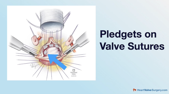 Modified David Procedure Pledgets on Sutures