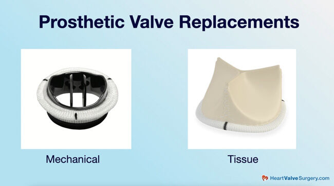 Prosthetic Heart Valve Replacements