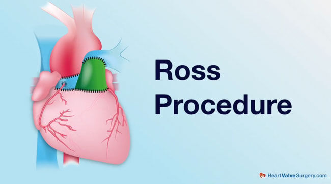 Ross Procedure Example