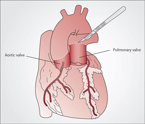 Ross Procedure Diagram with Scalpel