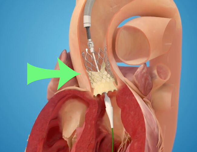 Medtronic TAVR Evolut