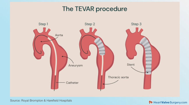 Drawing of the TEVAR procedure