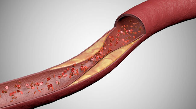 Coronary Artery Disease