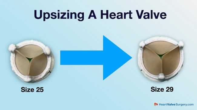 Upsizing an aortic valve for TAVR