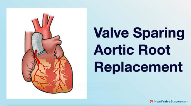 Valve Sparing Aortic Root Replacement