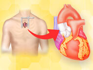 Minimally Invasive Aortic Root Replacement with Dr. Marko Boskovski