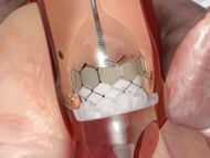 Patient Webinar:  Advances In Transcatheter Heart Valve Therapy
