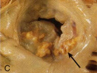 Mitral Annular Calcification: What Should Patients Know?