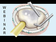 Patient Webinar: The Importance of Mitral Valve Repair