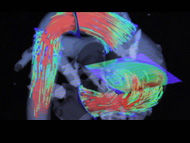 4D-MRI Advances Heart Valve Research & Treatment!