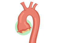 Surgeon Q&A: What Are Annual Growth Rates for Aortic Aneurysms?