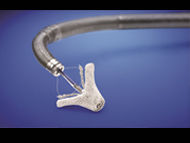 Ask Dr. Ailawadi: Is the MitraClip a Standard Procedure?