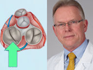 Dr. Vaughn Starnes: My Approach to Mitral Valve Surgery in 2020