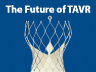 The Future of Transcatheter Aortic Valve Replacement (TAVR)