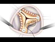 Webinar: Advances in Aortic Valve & Aneurysm Treatment