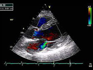 Using Echocardiogram Criteria to Diagnose Heart Valve Disorders with Dr. Randy Martin