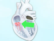 Patient Webinar: Advances in Tricuspid Valve Therapy