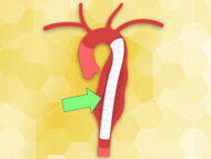 Is It Possible to Repair an Aortic Aneurysm Via Catheter?