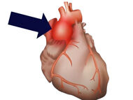 Surgeon Roundtable: The Interaction and Treatment of Aortic Valves and Aortic Aneurysms